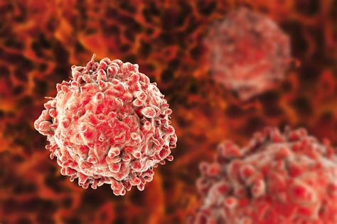 Leukemia .